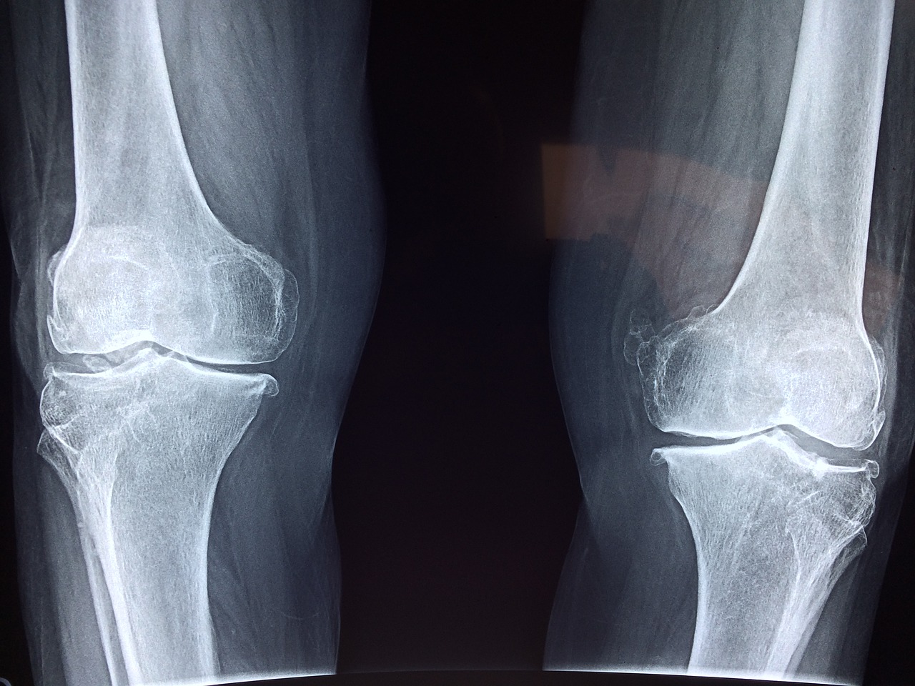 zdjęcie rentgenowskie kolana